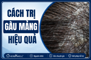 Cách trị gàu mảng
