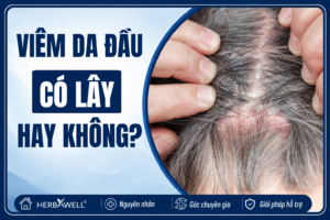 Viêm da đầu có lây hay không?