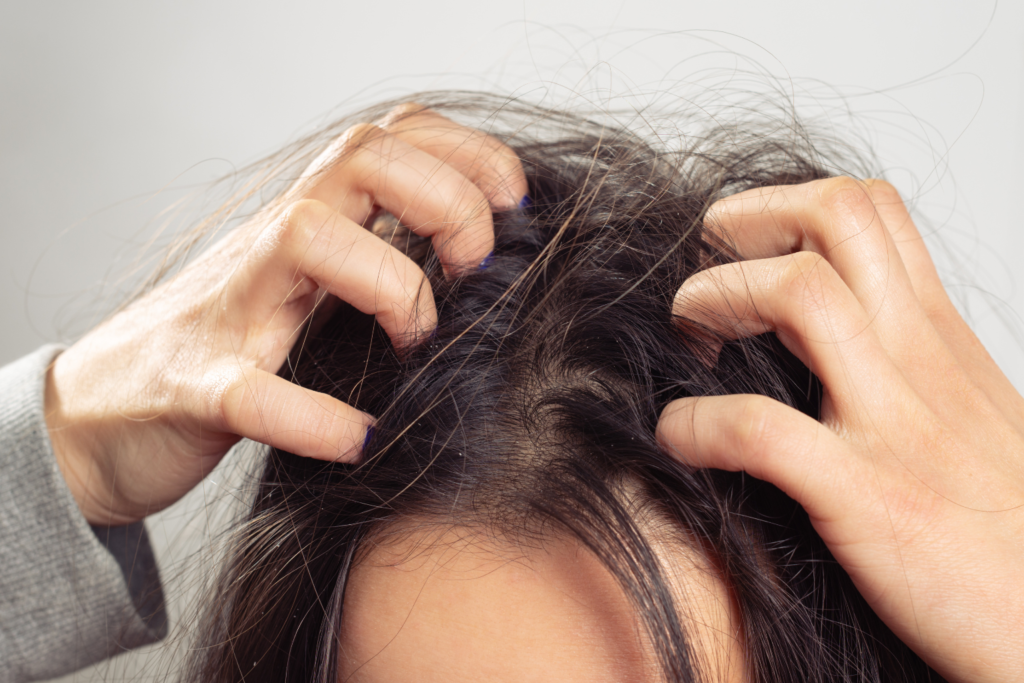 Gãi đầu liên tục có thể khiến tóc rụng nhiều hơn