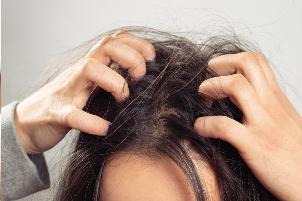 Ngứa da đầu gây cảm giác khó chịu